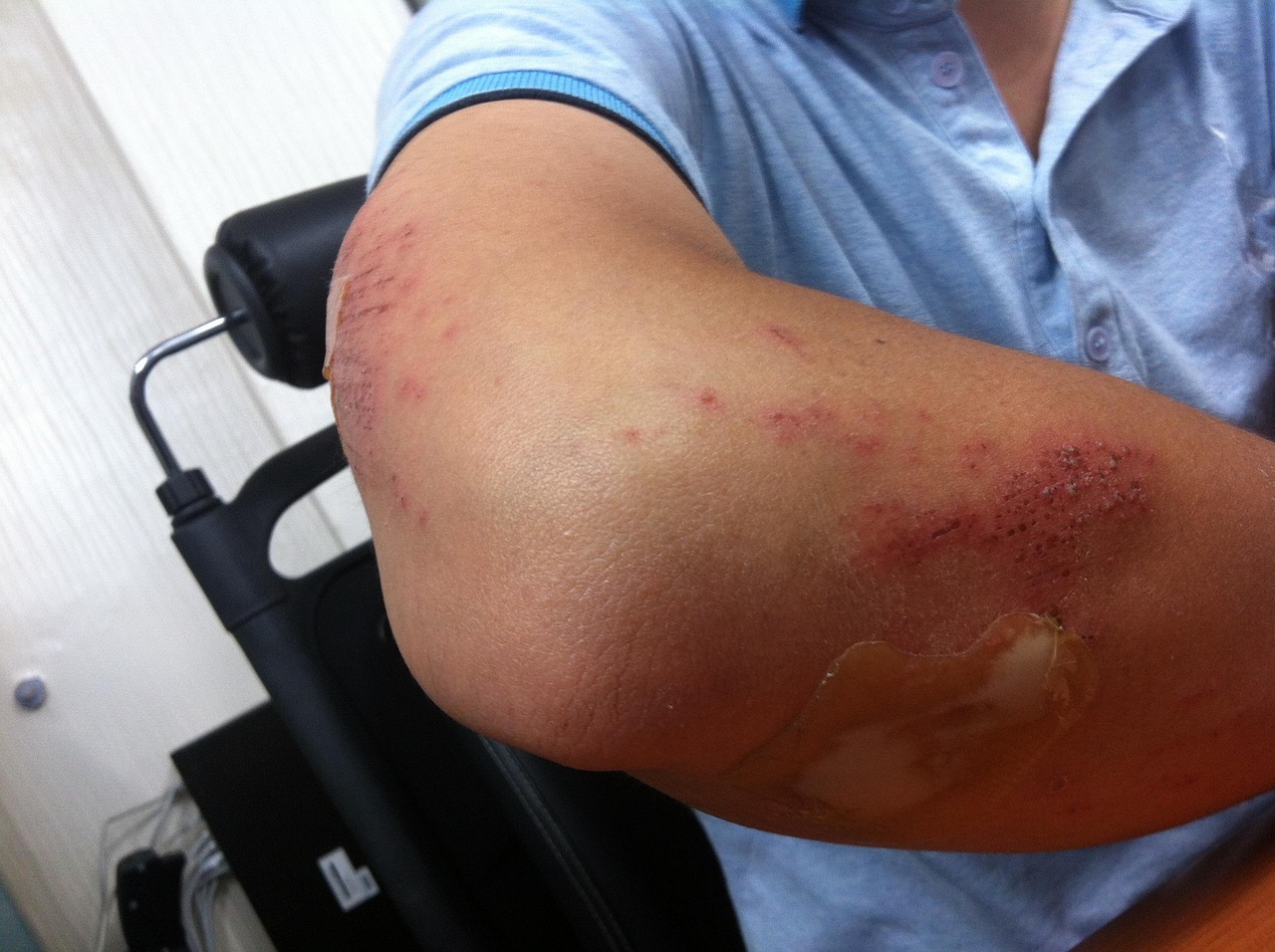 Psychosocial and Cultural Considerations in Wound Care