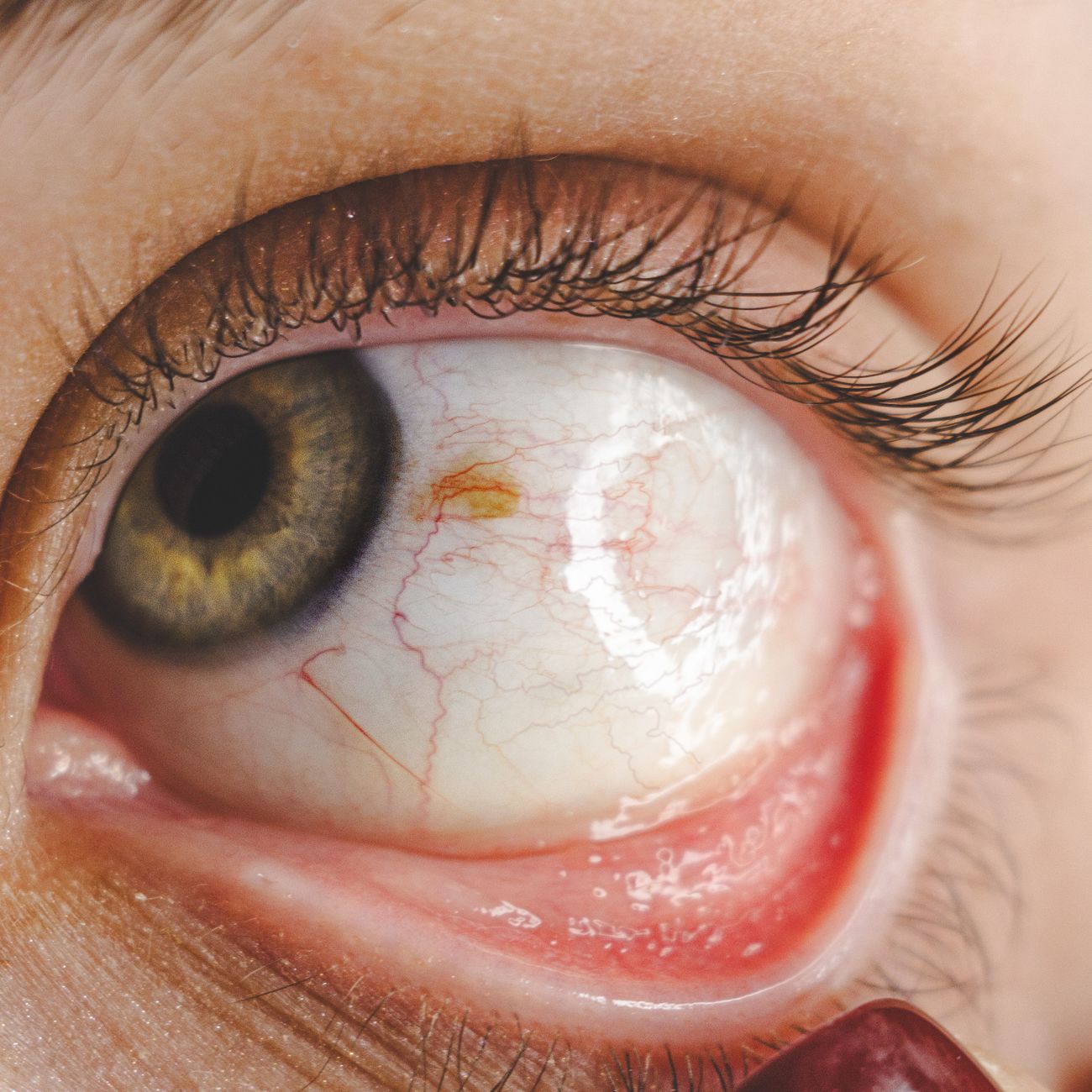 AI-driven Decision Support in Ophthalmology