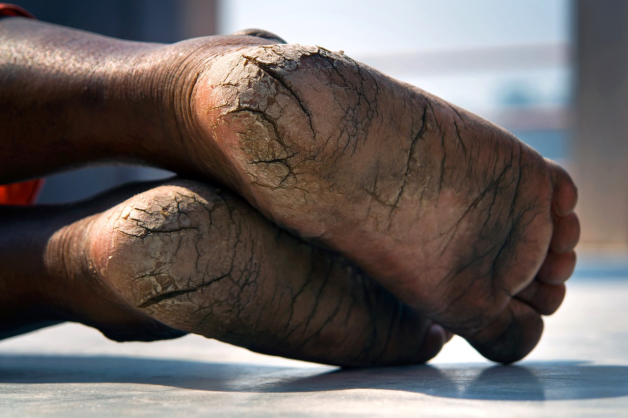 Skin Conditions and Nutrition
